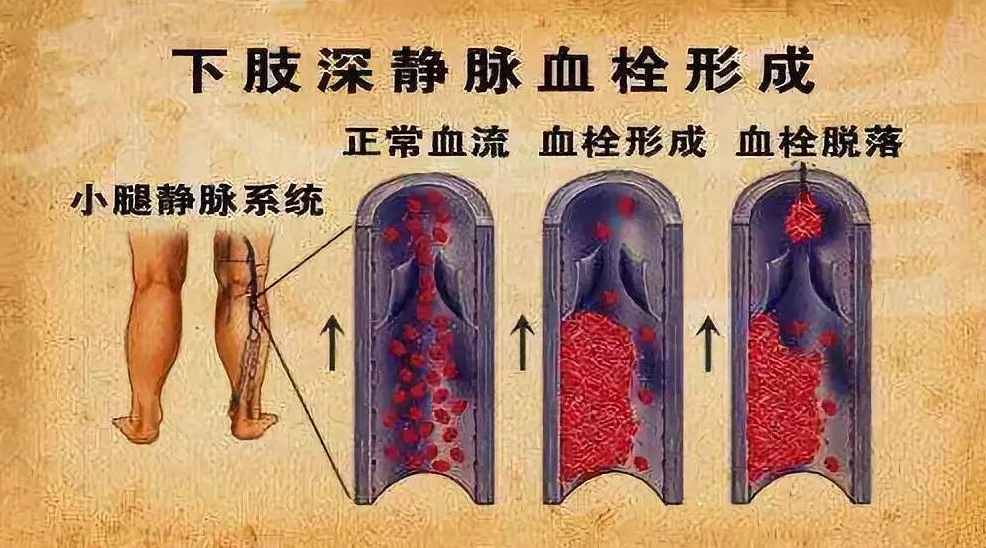 春节回家路漫漫,小心久坐遭血栓!